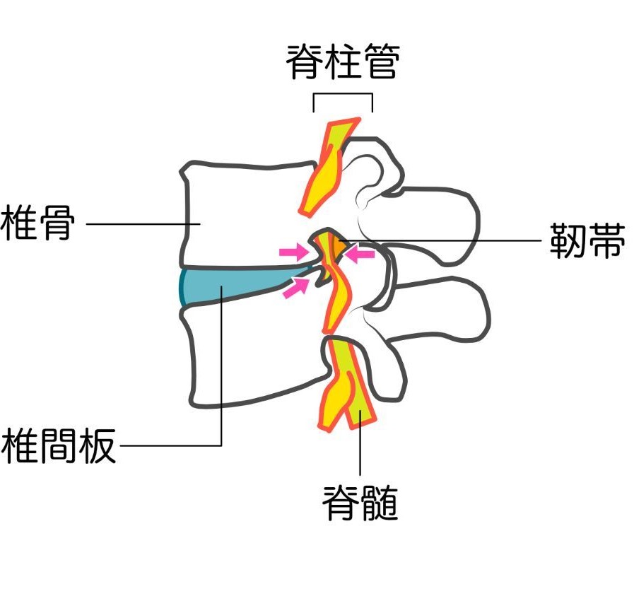 脊柱管狭窄症とは？